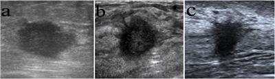 Ultrasound features for prediction of long-term outcomes of women with primary breast cancer <20 mm